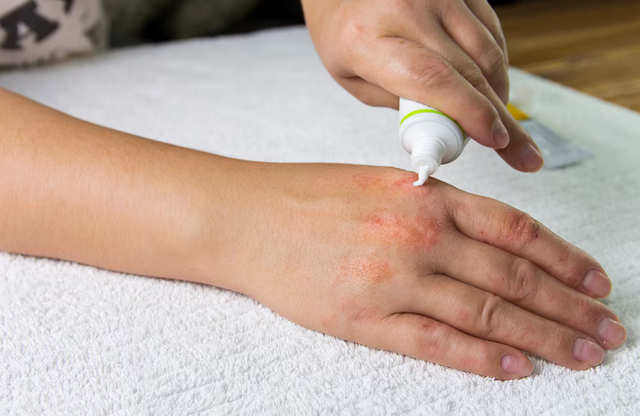 علاج الإكزيما (التهاب الجلد التأتبي)